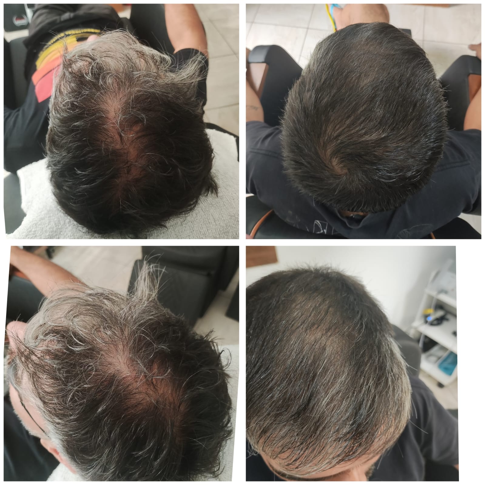 Antes e Depois