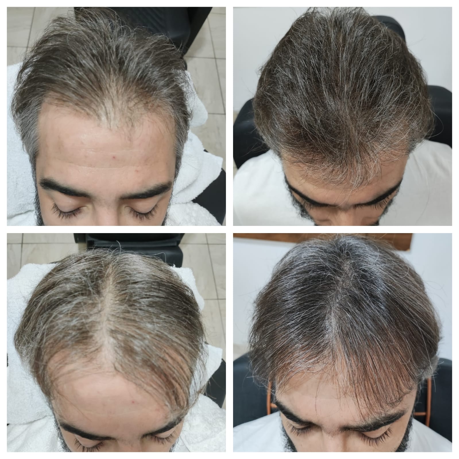 Antes e Depois